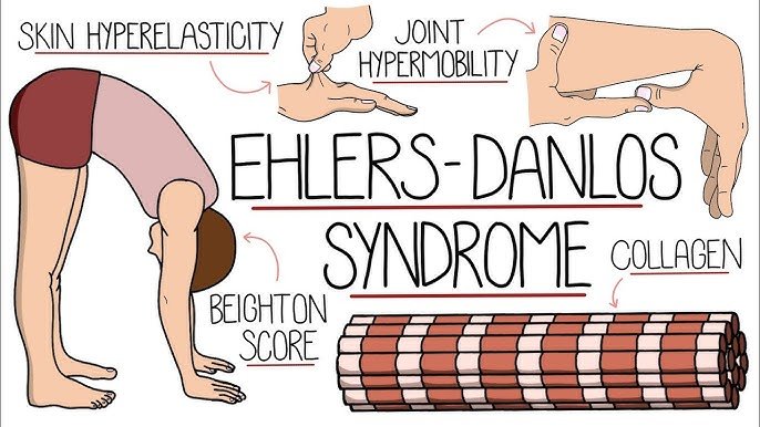 Understanding Ehlers-Danlos Syndrome: A Comprehensive Overview Ehlers ...