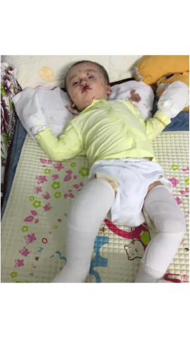 EB Babies & Specialized Medical Requirements: Awareness Campaign Announced EB Babies & Specialized Medical Requirements: Awareness Campaign Announced