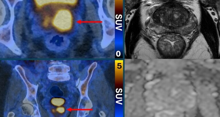 Scans That Make Prostate Cancer Cells ‘Glow’ Can Eliminate Invasive Biopsies and False Diagnoses