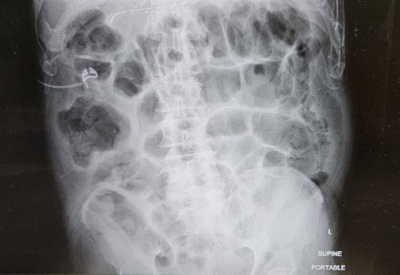 Small bowel obstruction patient education series: understanding trauma and emergency surgery conditions Small bowel obstruction patient education series: understanding trauma and emergency surgery conditions