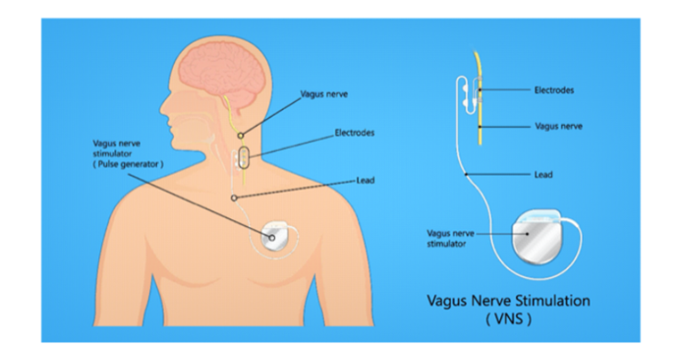 Vagus Nerve Stimulator Device Pulsetto Introduced to Support Relaxation, Stress Management, and Sleep Wellness