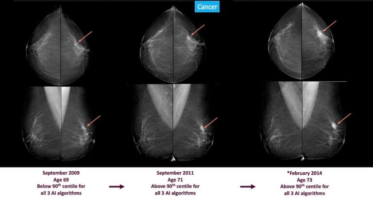 Signs of Breast Cancer Could Be Spotted 3-6 Years Before Diagnosis Using AI Screening, Shows Massive Study Signs of Breast Cancer Could Be Spotted 3-6 Years Before Diagnosis Using AI Screening, Shows Massive Study