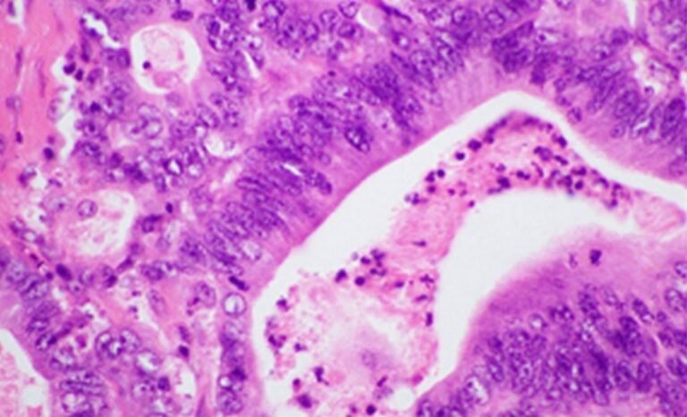 Experimental Drug Generates Immune Response Against Pancreatic Cancer in People at High Risk Experimental Drug Generates Immune Response Against Pancreatic Cancer in People at High Risk