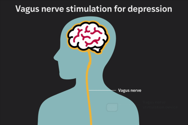 Pre- and Post-Surgery Mental Care Boosts Elderly Recovery Pre- and Post-Surgery Mental Care Boosts Elderly Recovery